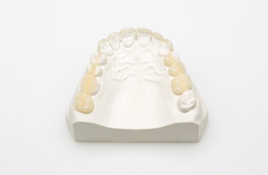 Lithium Disilicate facings inlay-onlay